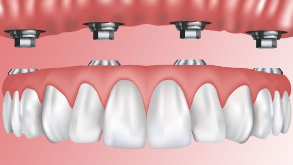 Upper And Lower Partial Dentures Bone Gap IL 62815